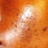 La pommade et la tisane traitent les boutons et taches noir dans le visage. le traitement adoucit et élimine les tâches noires sur votre visage.