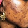 Guérir les problèmes de peau par un traitement traditionnel. Pommade et tisane adaptée lorsque la peau doit être hydratée et libérée des imperfections.